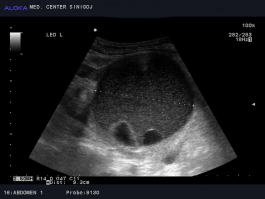 Ultrazvok ledvic - tumor z psevdocistama in želatinozno vsebino na ledvici